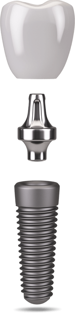 single dental-implant-model