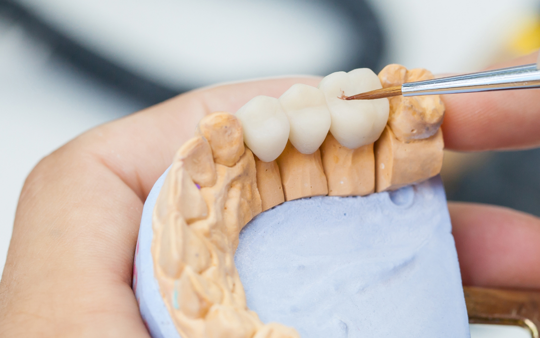 dental bridge model