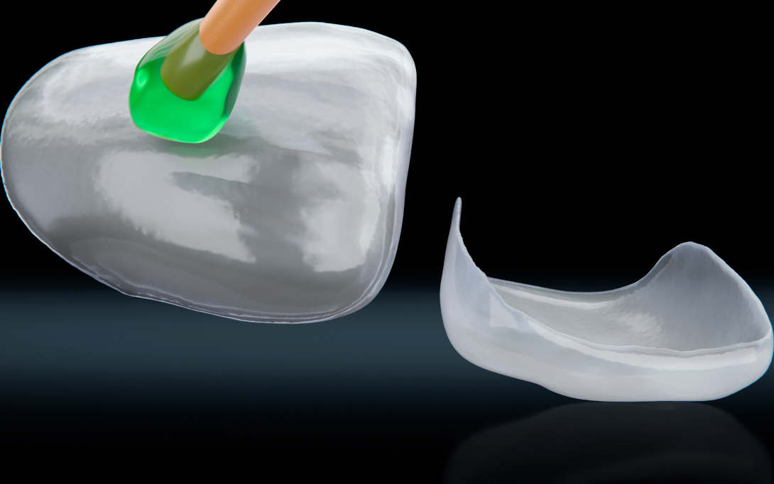 porcelain veneer model