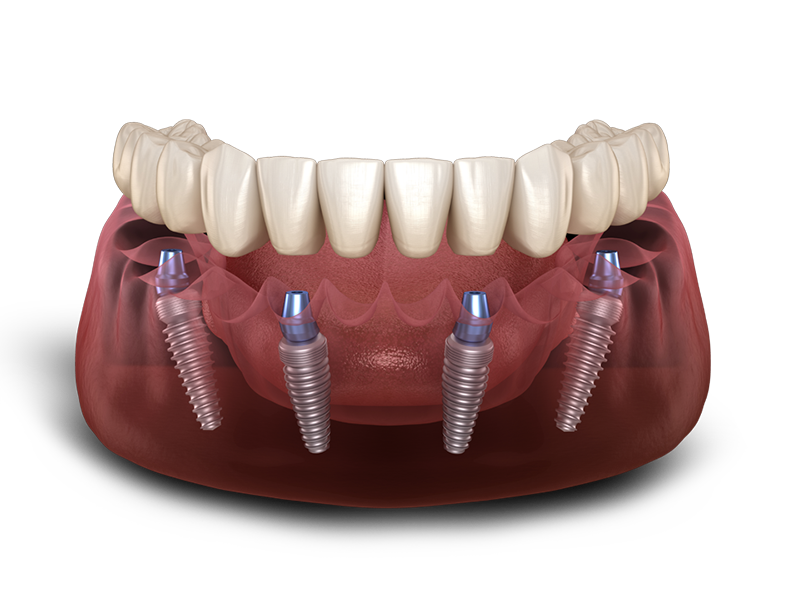 full arch dental implant model
