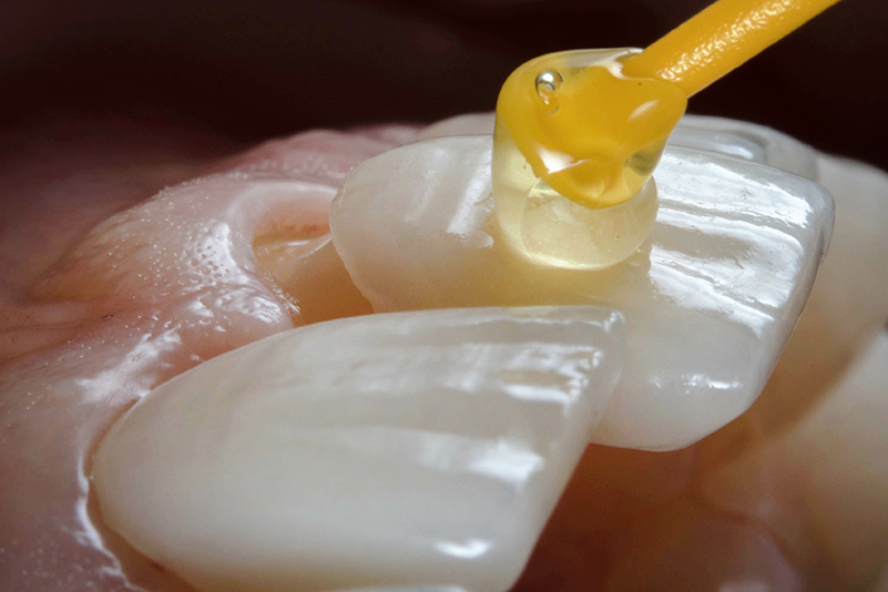 Porcelain veneers dental design