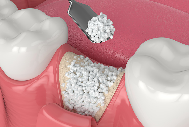 dental bone grafting