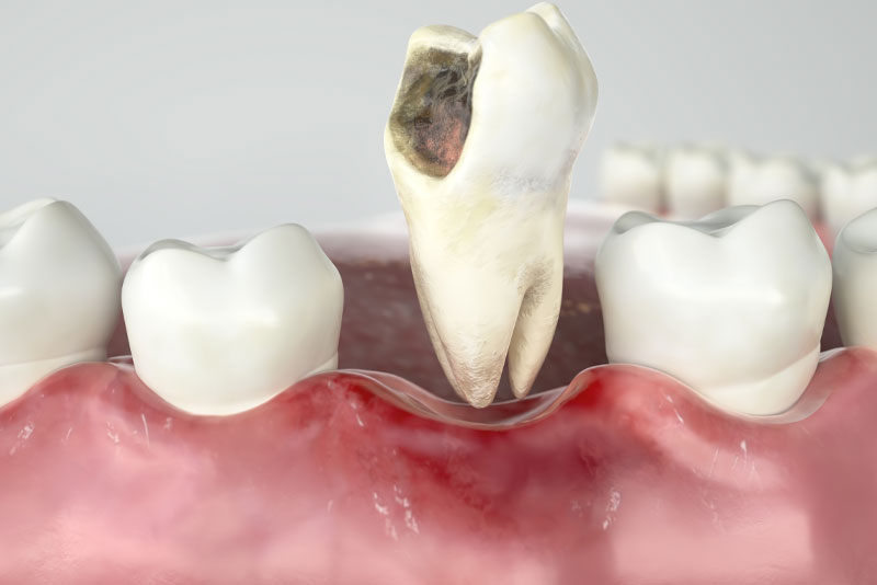 damanged-tooth extraction