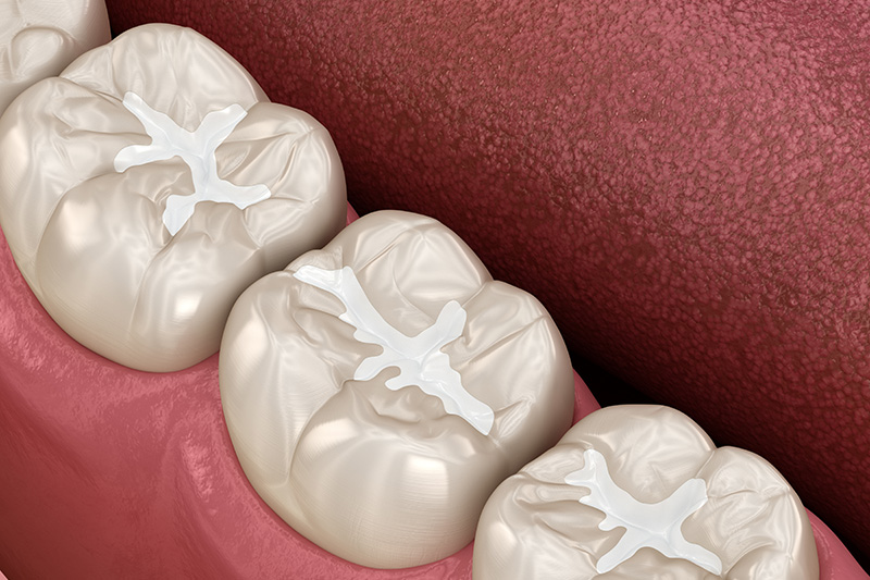 dental filling model