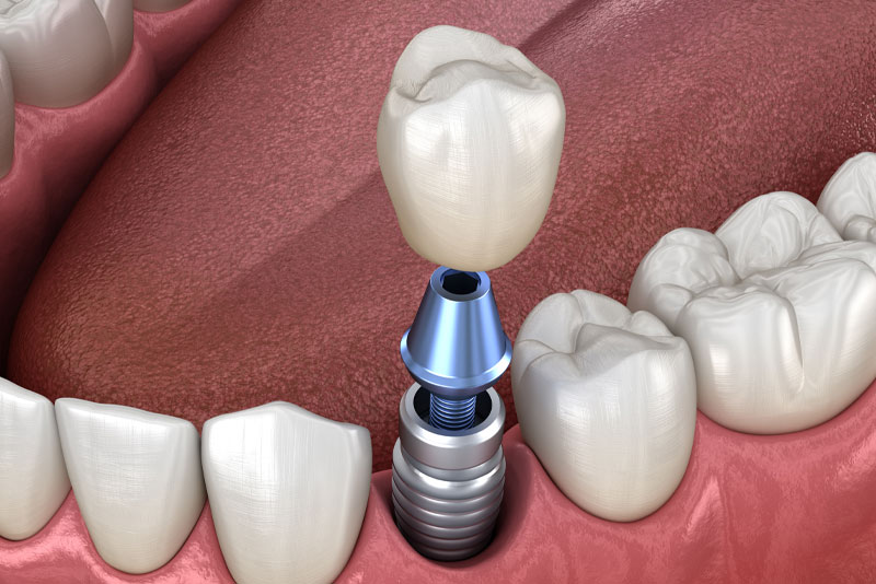 single dental-implant-model