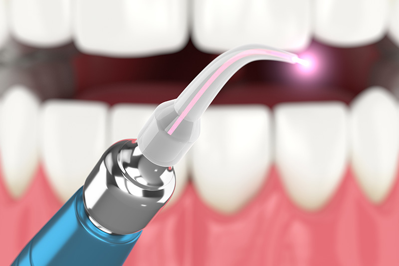 dental laser model