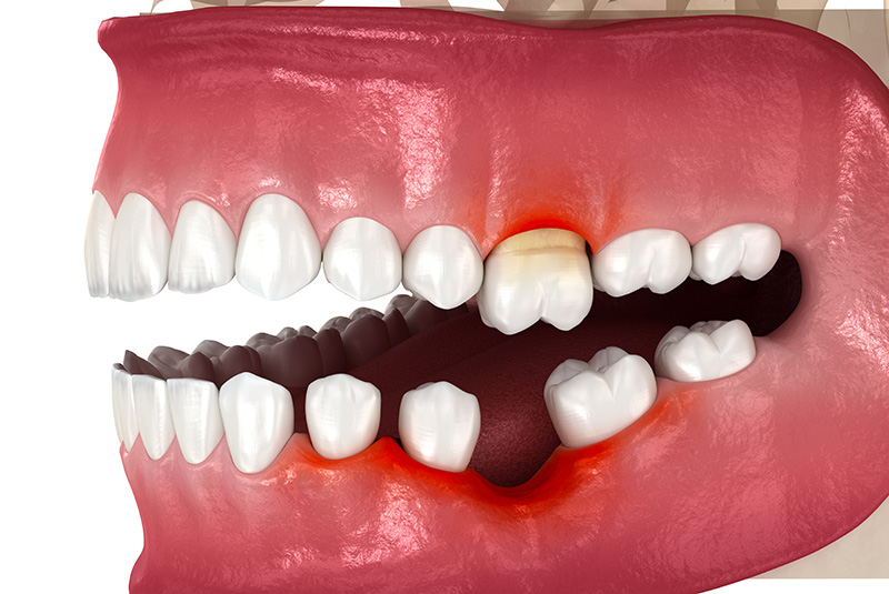 tooth dislodge