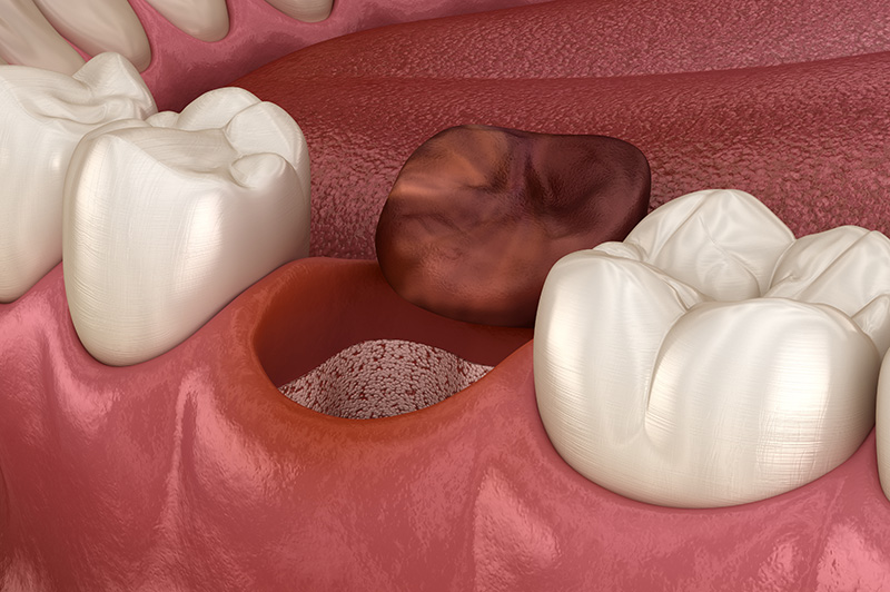 opened dry soket after tooth extractionopened dry soket after tooth extraction