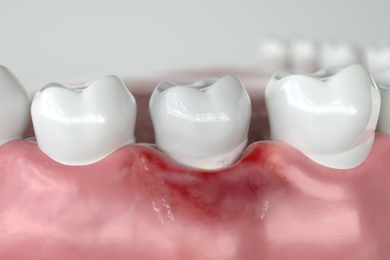 gum-disease-graphic
