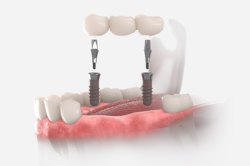 dental implant bridge model