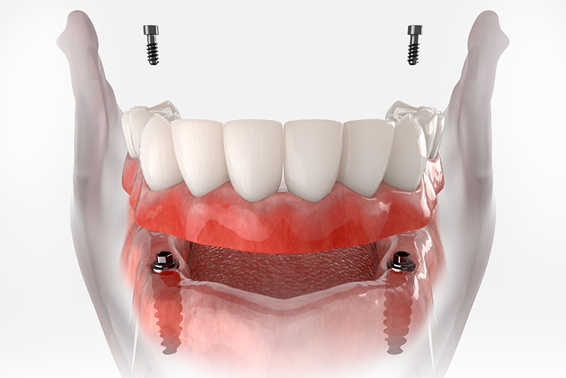 implant supported denture