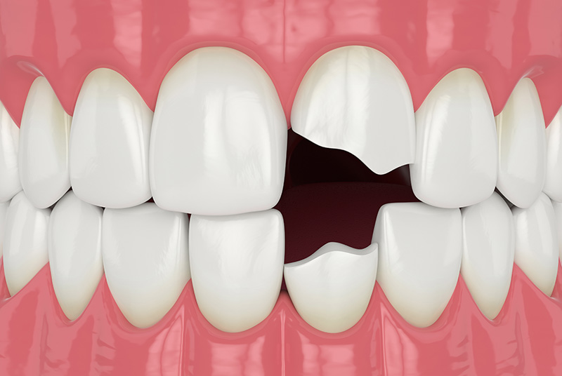 broken incisors teeth