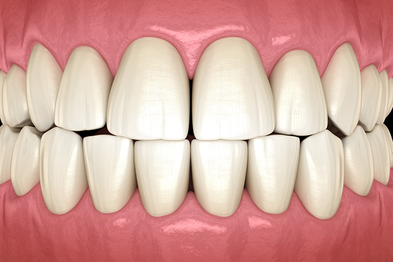 Traumatic Occlusion