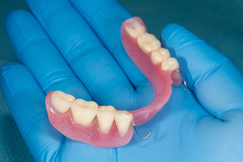 partial-denture model