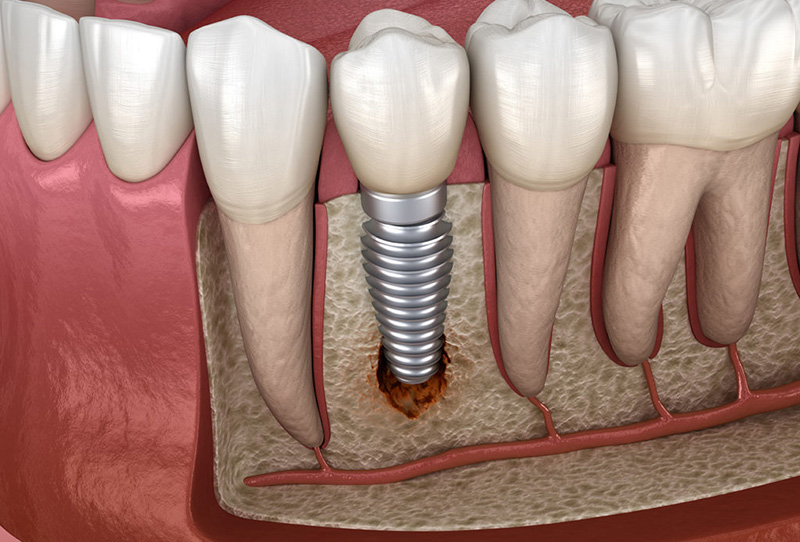 peri-implantitis
