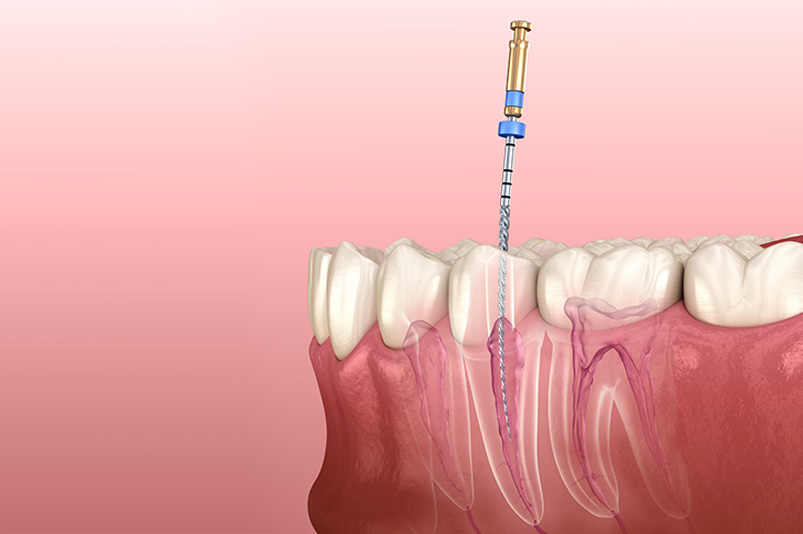 root canal model