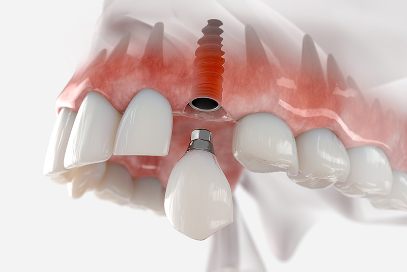 single dental implants model