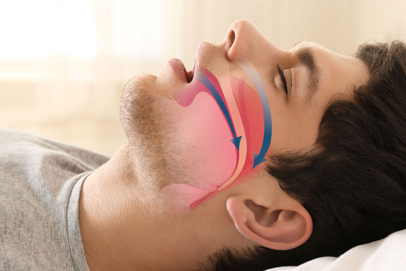 sleep-apnea graphic