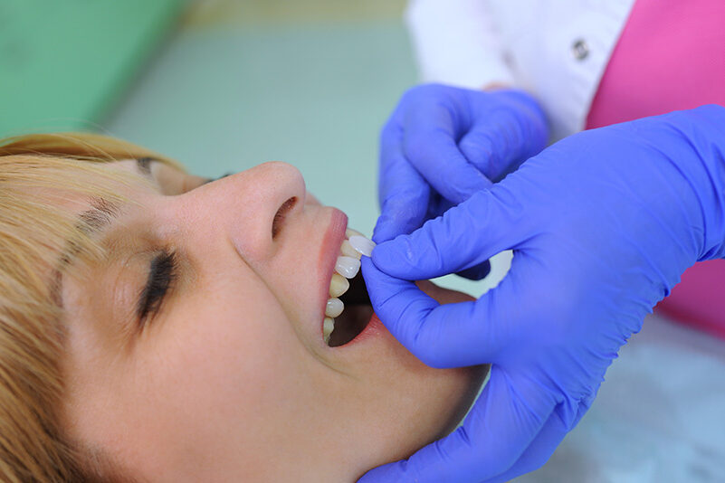 Dentist puts dental veneers patient and correction of teeth