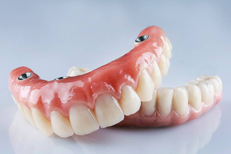 full arch-dental-implant model