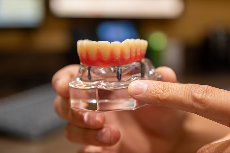 model of full arch dental implant