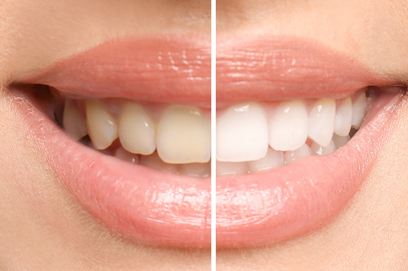Smiling woman before and after teeth whitening procedure,