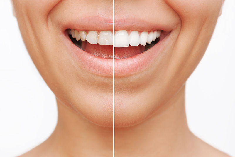 Smiling woman before and after porcelain veneer procedure,